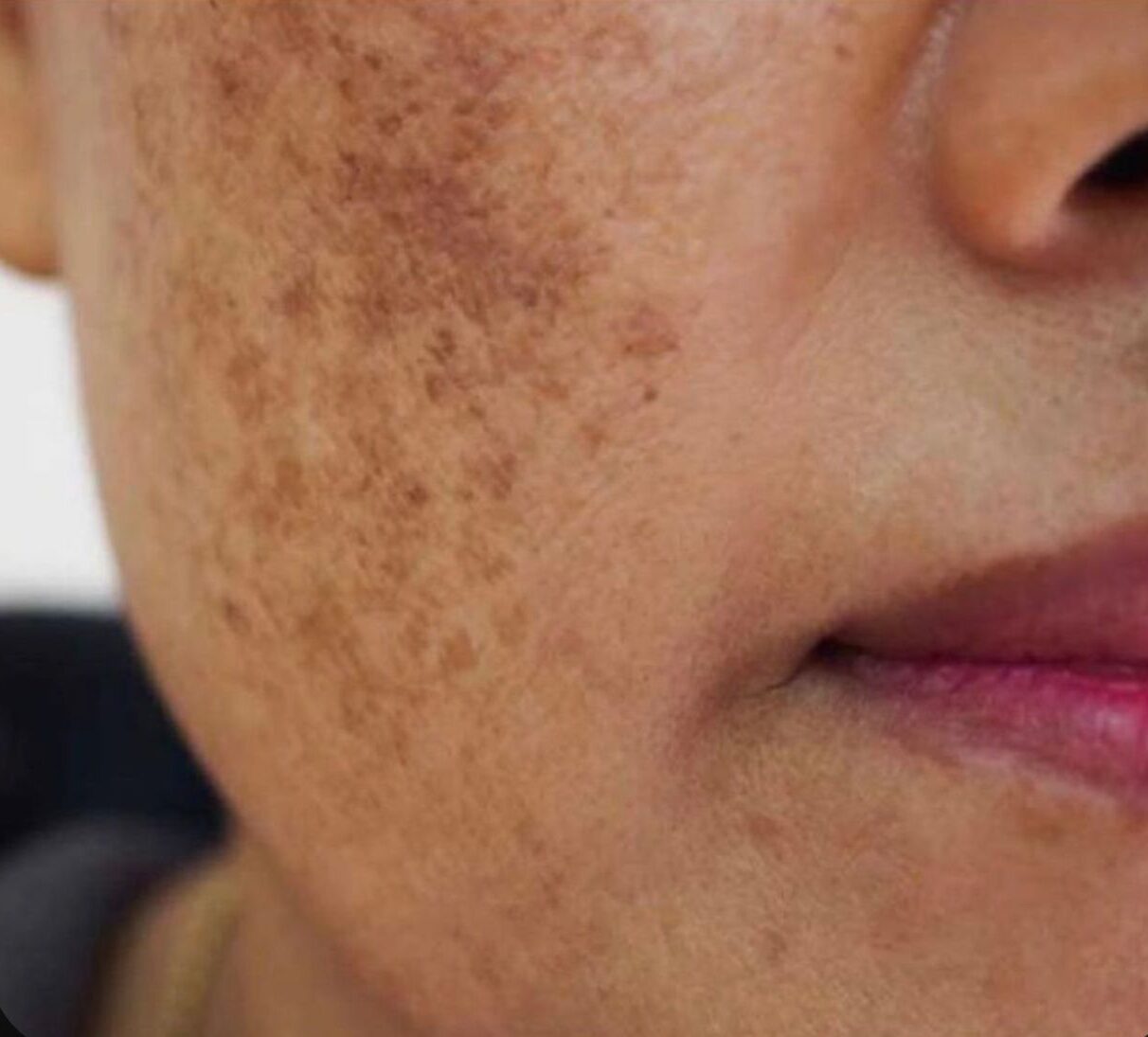 Metodat për trajtimin e hiperpigmentimit.